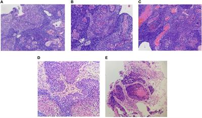 Dural and Multiple Brain Metastases From Basaloid Nasopharyngeal Carcinoma: Case Report and Literature Review